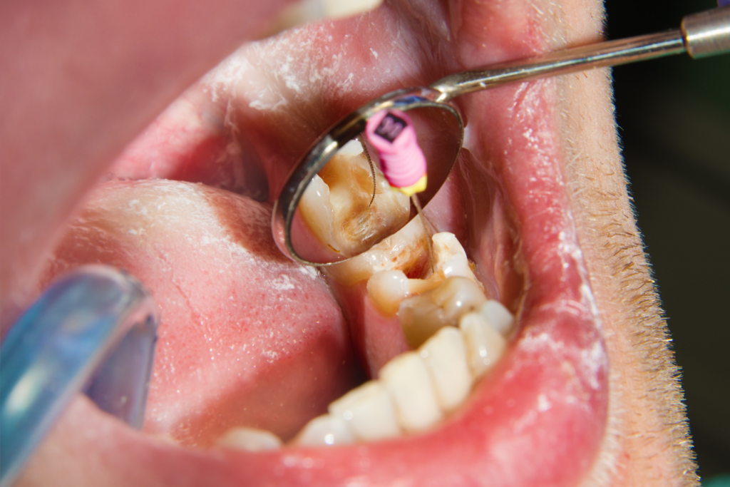 endodoncia en Castellón