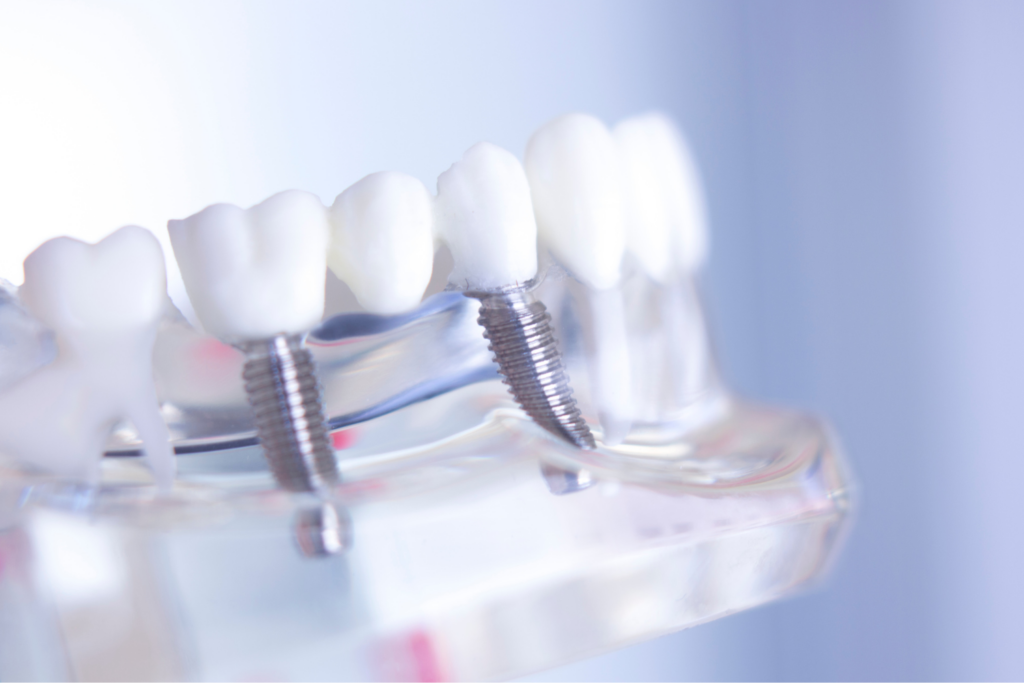 Implantes dentales