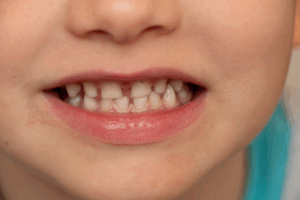 dientes de leche con caries